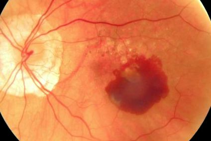 makula degeneráció tünetei retinopathia diabetica proliferativa