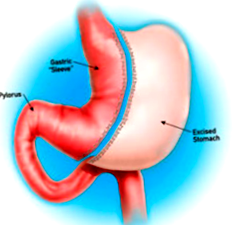 gastrectomia
