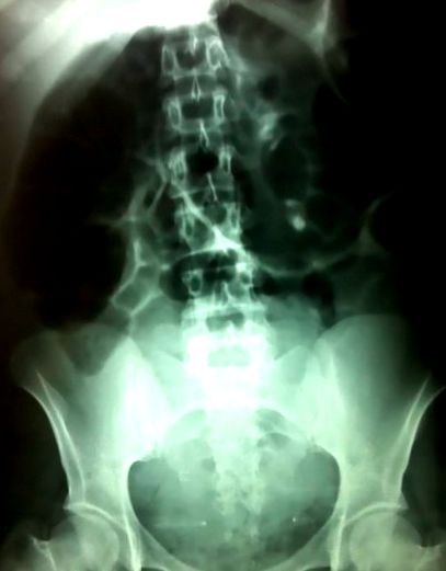 Szülés utáni nekrotikus sigmoid volvulus
