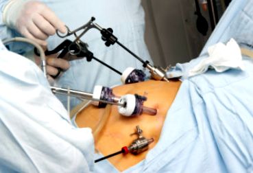 laparoscopice