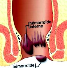 hemoroizii