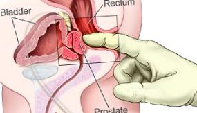Examinarea rectală a prostatei și rectului