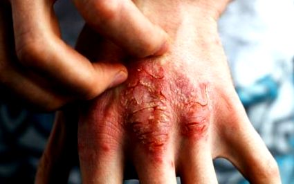 valóban gyógyítani pikkelysömör fórum does guttate psoriasis leave scars