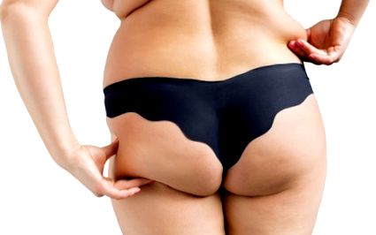 Hogyan lehet elveszíteni a zsírt a fenékről. Mi is az a zsírleszívás?