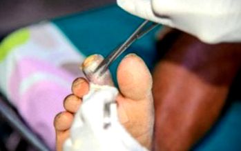 A lábak zsibbadása - Bőrkeményedés Hogyan kezeljük a fájdalmat a láblábain