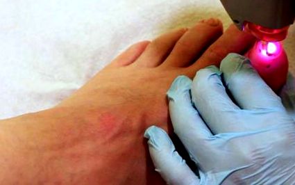 sebek lábak cukorbetegség sebek kezelésére