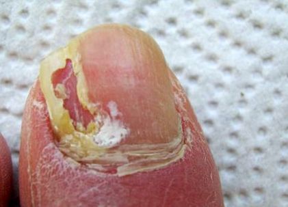 gombás köröm cseppek nail gomba homeopátia