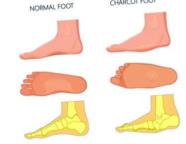 foot betegség cukorbetegség és a kezelés