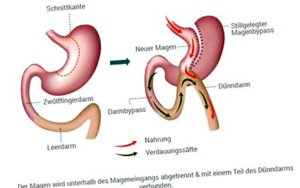 fogyás nyombél kapcsoló