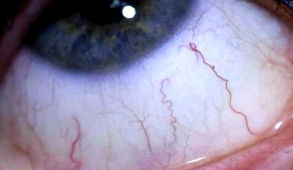 Paraziți oculari: simptome, cauze, tratament și prevenire Tratament cu paraziti oculari