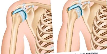 vállízület osteoarthrosis betegsége hogyan kell futni a térdízület artrózisával