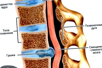 osteocondroza larg răspândită a coloanei vertebrale tratamentul condrozei regiunii cervicotoracice