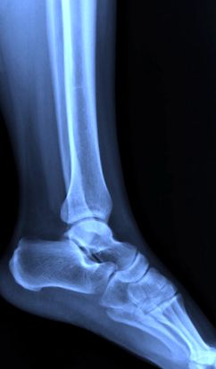 a láb osteochondrosisa