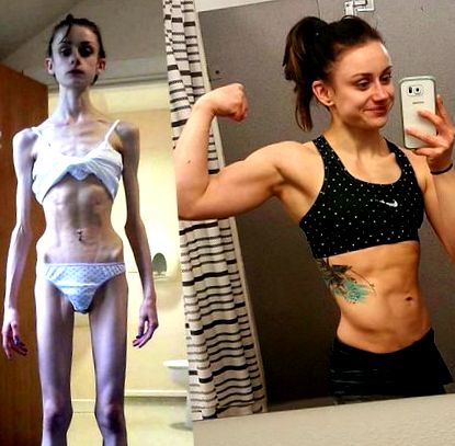anorexia pierdere în greutate înainte și după