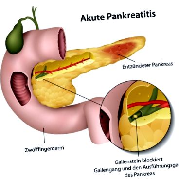 pancreatitis tünetei kezelése cukorbetegség)