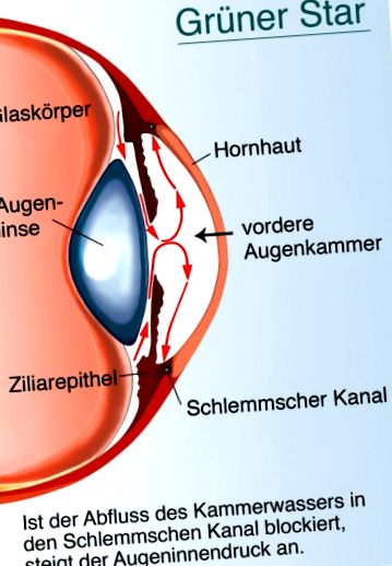 látás prognózisa glaukómában