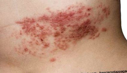 Zsindely (herpes zoster)
