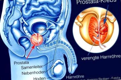 prosztata műtéti eljárások augmentin és prostatitis
