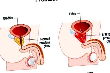prequooling a prostatitis alatt