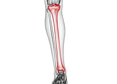 az alsó lábszárcsont artrózisának törése utáni kezelés)