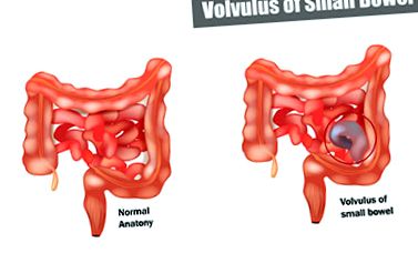 Volvulus (încurcarea intestinului) - cauze, simptome și tratament