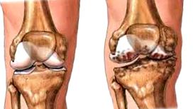 artroza udarnog vala koljena bol u zglobovima latinski