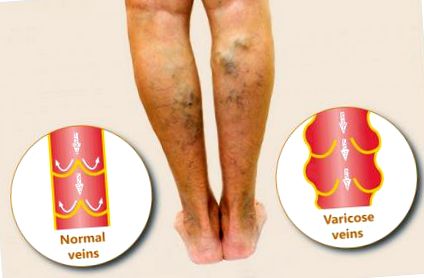 tratamentul cu tratare a piciorului varicose