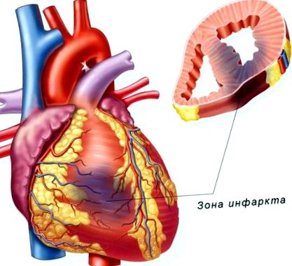 остеопороз