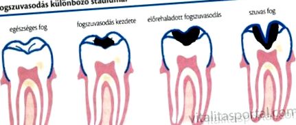 cariilor dentare