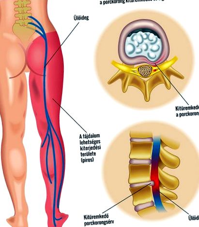Artroza coloanei vertebrale - Artroza tratamentului articulațiilor coloanei vertebrale