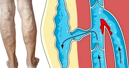 Articulațiile crunch modul de a trata, Modul de a trata artrita în articulațiile degetelor
