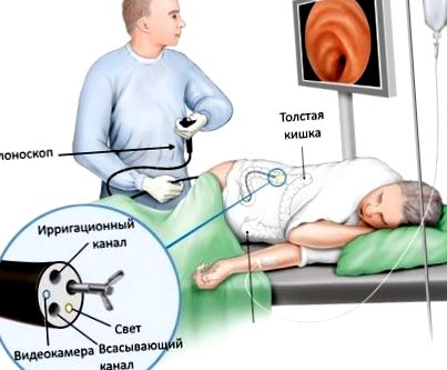 колоноскопії