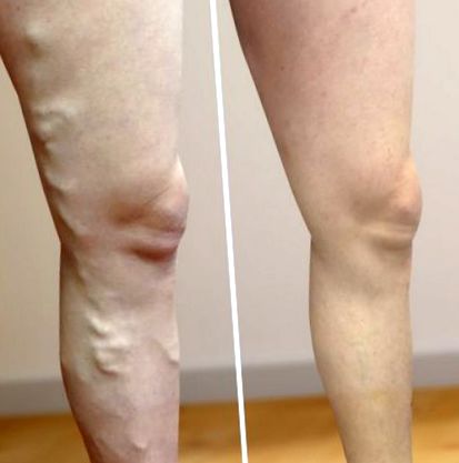 Рубрика: Ulcere trofice ale picioarelor asociate cu varice