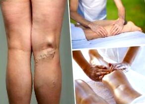 tratamentul venelor varicoase mitino picioare grele si umflate