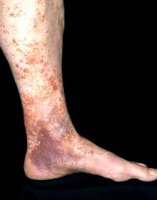 Medicamente pentru venele varicoase profunde - Dieta pentru varicele la nivelul picioarelor