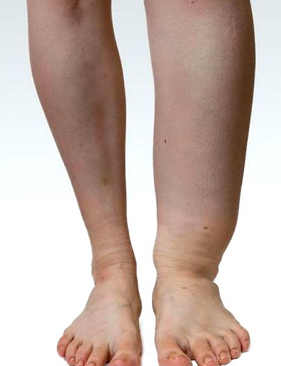 umflarea picioarelor în tratamentul venelor varicoase