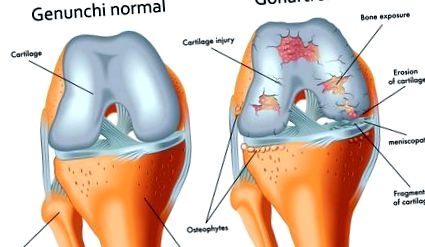 térdízület ízületi gyulladás esetén lehet táncolni deformáló artrosis a vállízület