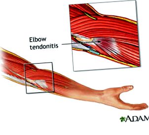 mi az artrózis plazmolifting kezelése nagy lábujj ízület sérülései