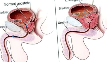 prostatitis a férfiakban a rák jelei
