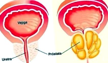 Jelk prosztatitis A prostatitis férfiaknál veszélyes