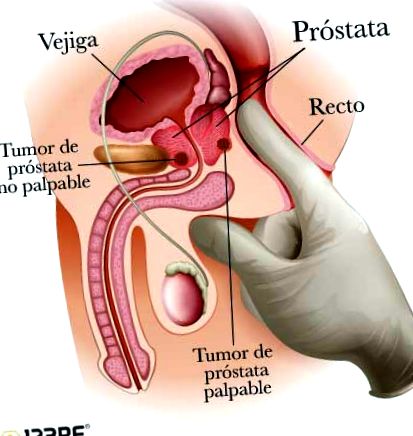 A prostatitis befolyásolja a beleket