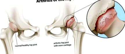 A csípőízület arthrosisának megnyilvánulása