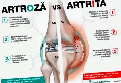 Osteoartritis / artroza