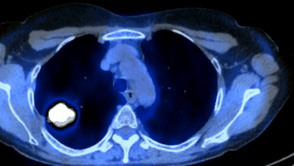 A CT mutat metasztázist, tumort?