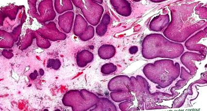 Intraductalis papilloma atipikus ductalis hyperplasia, A patológiai jelentés megértése: Mellrák