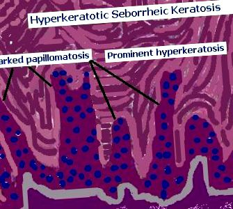 Hyperkeratosis papilloma - A Hpv rák Hyperkeratosis papillomatosis és acanthosis