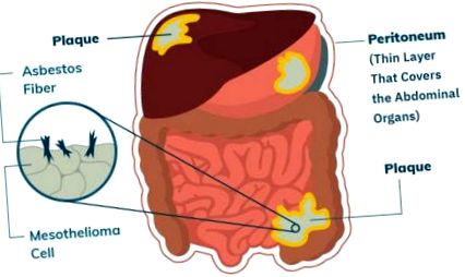 peritoneális rák stádiumai