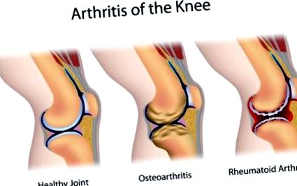 az osteoarthritis súlyosbodása