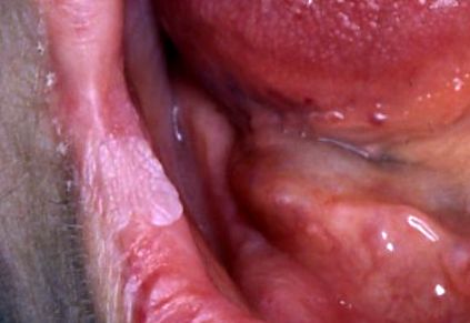 Papillómák az ajkakon kezelés. A száj neoplazma jelei