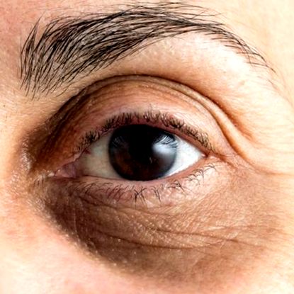hogyan lehet elveszíteni a szem alatti zsír